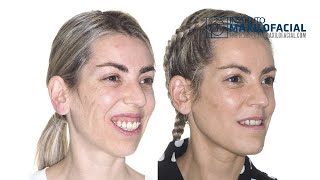 Jaw surgery Case  85 Marjorie Class II gummy smile biprotrusion [upl. by Menard]