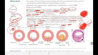 Arteriosclerosis 2  BACK BENCHERS ACADEMY [upl. by Anelhtak680]