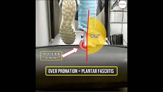 Understanding Plantar Fasciitis amp Over Pronation How Orthotic Insoles Can Help Control and Relieve [upl. by Nirok]