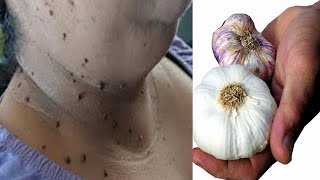 diy skin tag removal in 3 day  skin tag removal natural remedies with lemon remedy [upl. by Htenek]