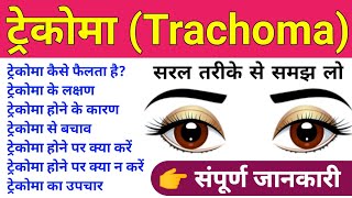 Trachoma Disease in Hindi  Trachoma Causes Symptoms Treatment Prevention  ट्रेकोमा रोगबीमारी [upl. by Fanchie]