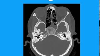 Neuroradiology spotters Dr M Venkatesh [upl. by Siward]