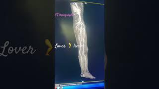 CT scan  Venography lover limb 🦵 [upl. by Brig]