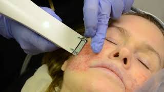 Skin Tightening with A Profound RF Treatment [upl. by Eceeryt]