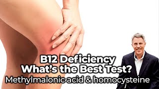 B12 Deficiency  what’s the best test Methylmalonic acid amp homocysteine  FORD BREWER MD MPH [upl. by Suolekcin]