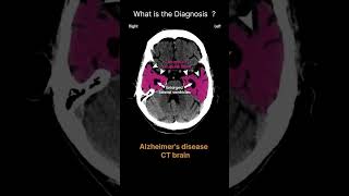 Alzheimers disease  CT brain Acute CT Brain Brain volume 56 radiologychannel007 [upl. by Nickolas]