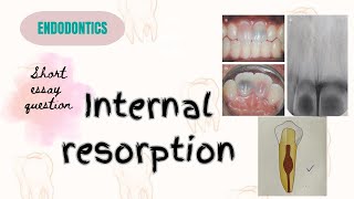 Internal resorptionEndodonticsshort essaywith easy notesimportantquestions easy dentalstudies [upl. by Hairom]