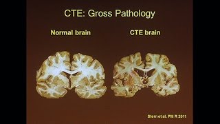 Chronic Traumatic Encephalopathy [upl. by Swords]