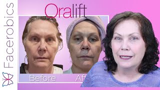 ORALIFT amp Facerobics Trial Results  See My RESULTS  I Am Thrilled [upl. by Roseline]