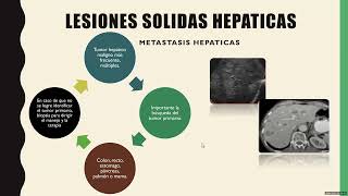 11 Lesiones ocupativas hepáticas [upl. by Alston998]