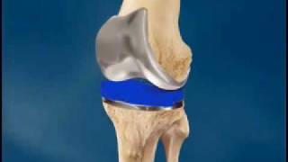 Total Knee Replacement Surgery Arthroplasty  University of Vermont Medical Center Vermont [upl. by Cyprio546]