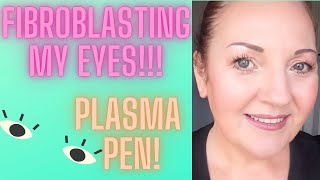 FIBROBLASTING MY EYES PLASMA PEN [upl. by Anne-Marie314]