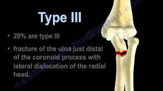 Monteggia Fracture Dislocation  Everything You Need To Know  Dr Nabil Ebraheim [upl. by Asnerek704]