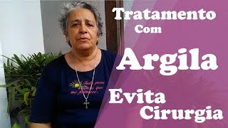 TRATAMENTO COM ARGILA EVITA CIRURGIA DE CATARATA Depoimento [upl. by Arman856]