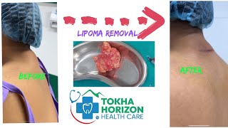 lipoma removal of nape of neck  dr bijay  tokha horizon [upl. by Michelina]