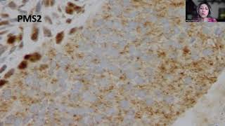 Tip42MMR Stains in Endometrial Carcinoma [upl. by Cahra791]