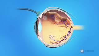 Vitrectomy Surgery for Detached Retina [upl. by Knowling668]