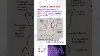 Down syndrome neet usmle pathologyacademy draditikumar [upl. by Anahsit319]