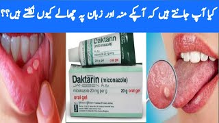 How To Cure Mouth BlistersBeat Oral Jell Daktarin For Blisters By Sanam [upl. by Annabelle123]