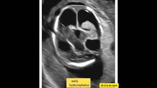 Early hydrocephalus radiology ultrasoundscans ultrasound radiography DoItInTheDark [upl. by Harhay408]