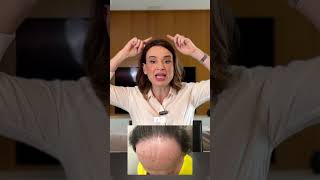 Alopecia Fibrosante Frontal como reconhecer [upl. by Aivat]