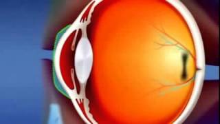 ▶ Lentillas OrtoK Cómo funcionan en un corto vídeo [upl. by Hael394]