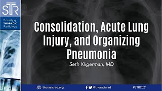 HRCT Consolidation Acute Lung Injury and Organizing Pneumonia [upl. by Heimlich]