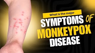 Monkeypox symptoms and treatment in hindi [upl. by Norrabal]