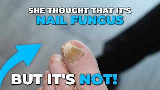 IF ITS NOT A NAIL FUNGUS THEN WHAT IS IT [upl. by Kathlin]