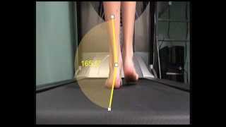 Over Pronation and how this is measured in walking [upl. by Alysoun]