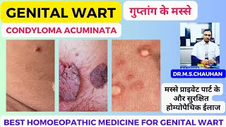 The Ultimate Cure Homeopathic Medicine for Genital Warts [upl. by Irehj961]