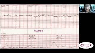 CARDIOTOCOGRAFÍA FETAL DE PATRÓN NORMAL Y PATOLÓGICO CLASE V [upl. by Rock]