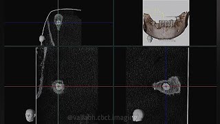 SALIVARY GLAND STONE CBCT CASE REPORT [upl. by Eneluj]