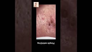 Blackheads Removal  Acne Treatment and Very Satisfying Satisfying Pimple pop blackheads [upl. by Leahcimsemaj]