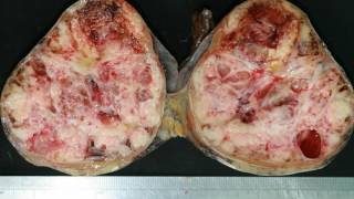 Difference Between Teratoma and Seminoma [upl. by Hinkel]