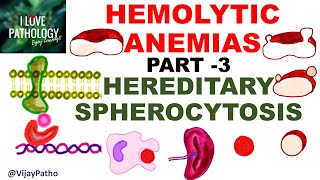 Hemolytic Anemias Part 3 HEREDITARY SPHEROCYTOSIS [upl. by Amat725]