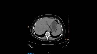 stone in ureter ctscan [upl. by Beeck]