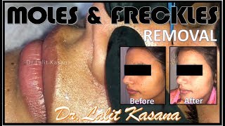 MOLES AND FRECKLES REMOVAL BY DRLALIT KASANA [upl. by Ayanej963]