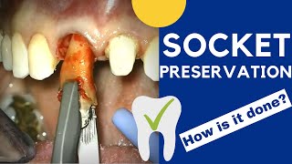 Tooth extraction and SOCKET PRESERVATION  How is it done [upl. by Ademla461]