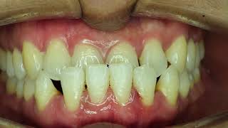 Can you Have Braces or Clear Aligners and Periodontal Disease [upl. by Yajiv]