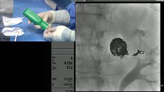 Transradial Coil Embolization of a Renal Artery Aneurysm [upl. by Silverstein]