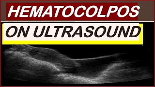 Hematocolpos on ultrasound [upl. by Grimbly]