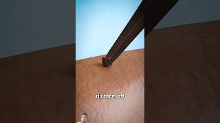 How to remove skin tags animation doctor science medicalanimation anatomy 3d animation [upl. by Ambur]