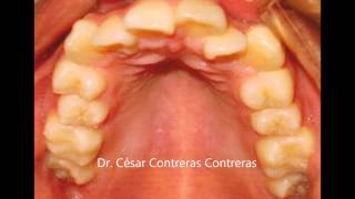 Ortodoncia Caso OBPT Antes y Después Dr César Contreras C [upl. by Pages]