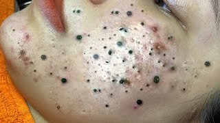 Big Cystic Acne Blackheads Extraction Blackheads amp Milia Whiteheads Removal Pimple Popping  6865 [upl. by Nafis540]