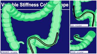 COLONOSCOPY Olympus Total [upl. by Heloise]