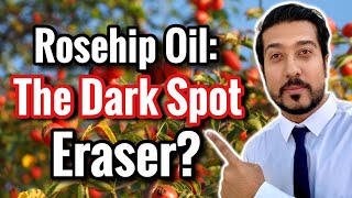 Rosehip Oil for Dark Spots in Melasma and Hyperpigmentation [upl. by Divadnoj]