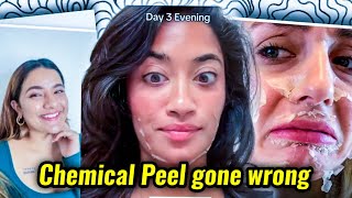 INFLUENCERS NEED TO STOP PROMITING CHEMICAL PEEL AS BEAUTY TREATMENT [upl. by Auberbach]