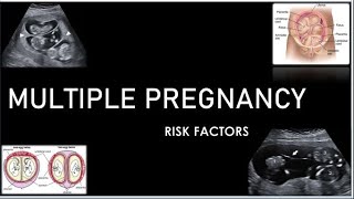 Multiple Pregnancies Risk Factors [upl. by Mharba271]