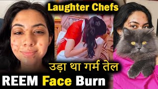 Laughter Chefs Episode  Reem Face Skin Burn  चेहरे पर उड़ा था गर्म तेल [upl. by Armallas430]